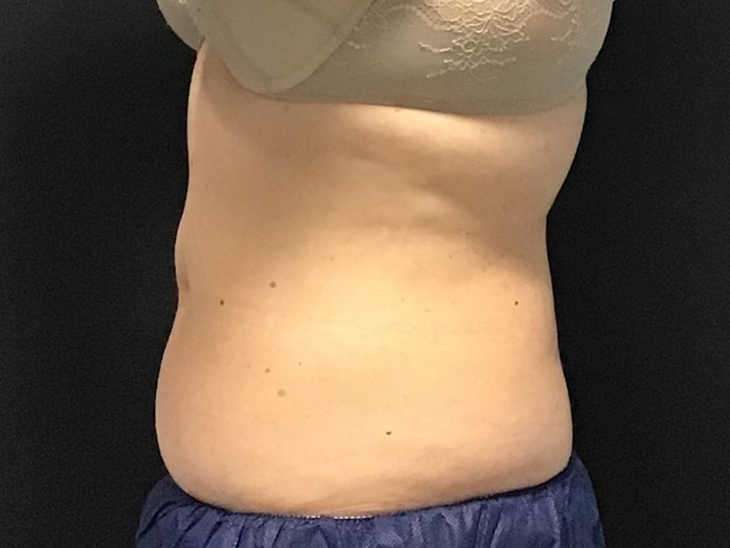 CoolSculpting Before & After Image