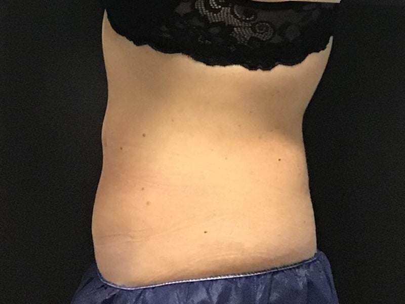 CoolSculpting Before & After Image