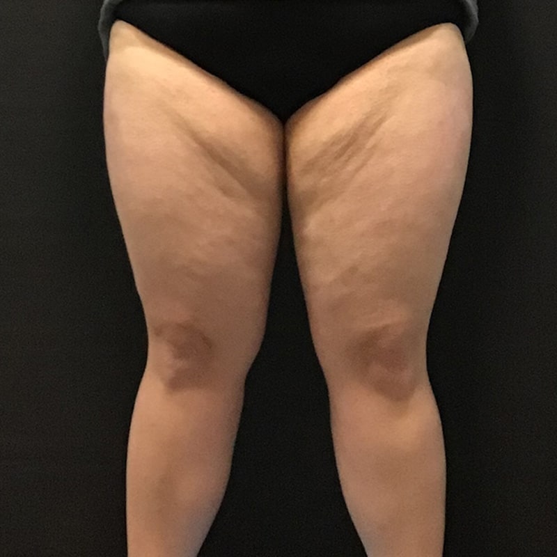 CoolSculpting Before & After Image