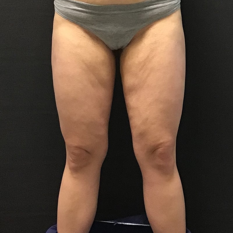CoolSculpting Before & After Image