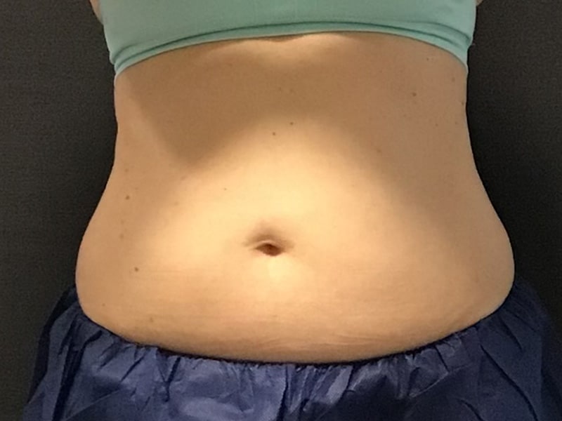 CoolSculpting Before & After Image