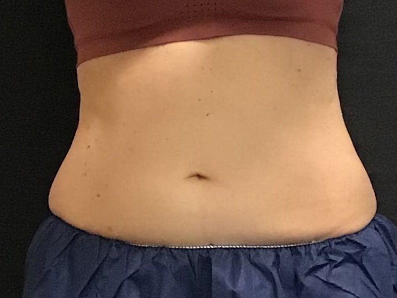 CoolSculpting Before & After Image