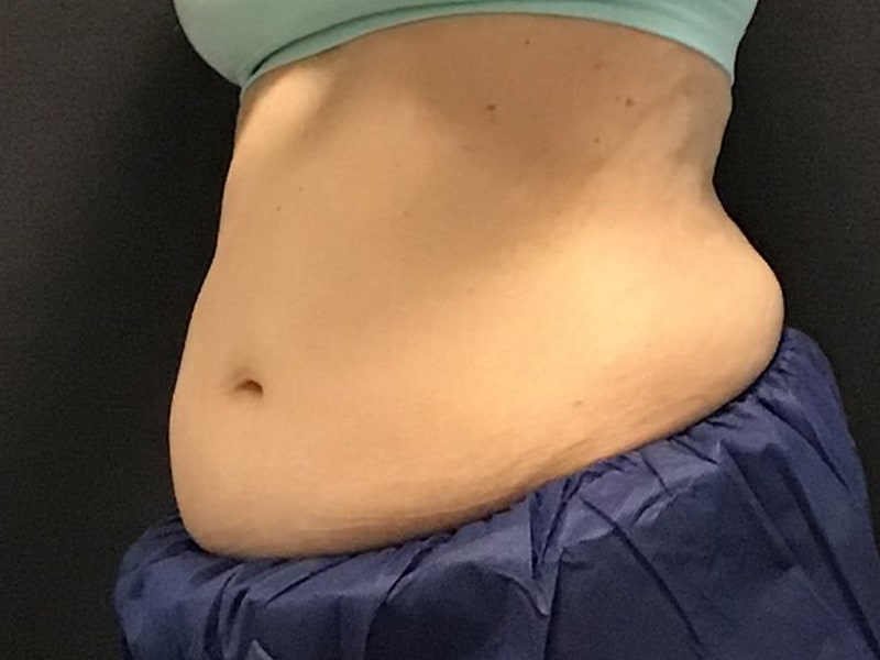 CoolSculpting Before & After Image