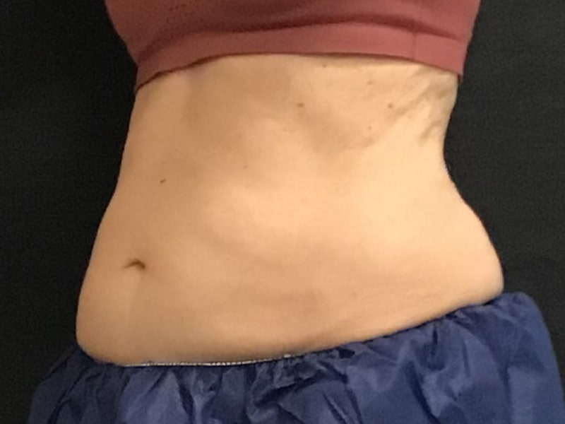 CoolSculpting Before & After Image