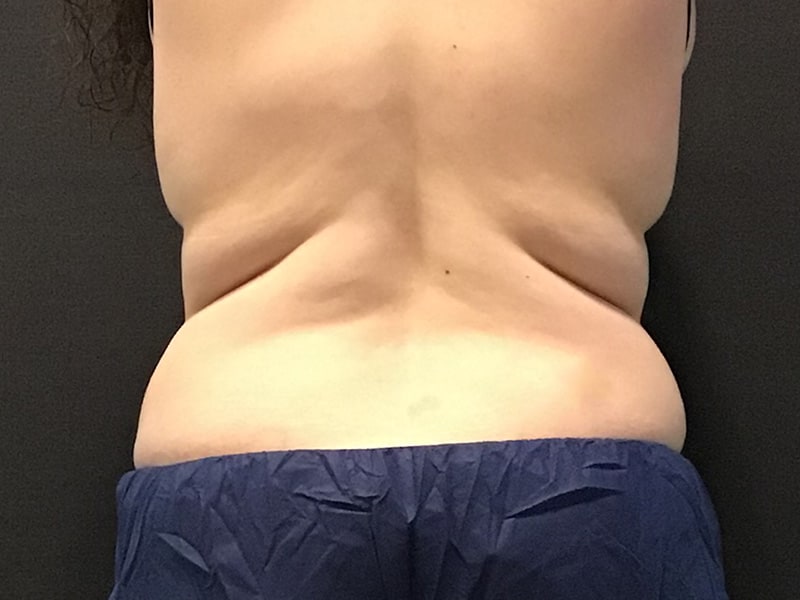 CoolSculpting Before & After Image