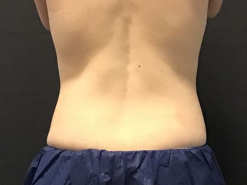 CoolSculpting Before & After Image