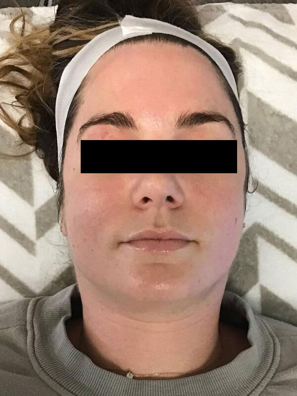 Hydrafacial Before & After Image