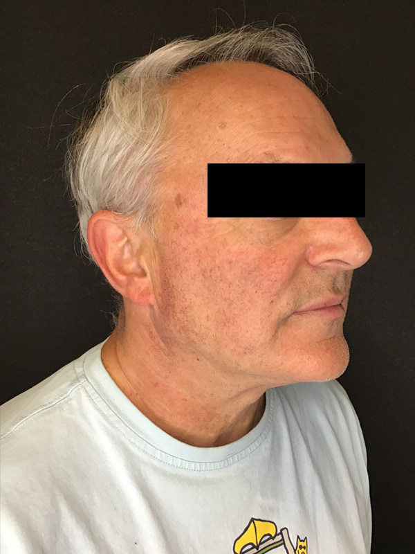 Sciton BBL Before & After Image
