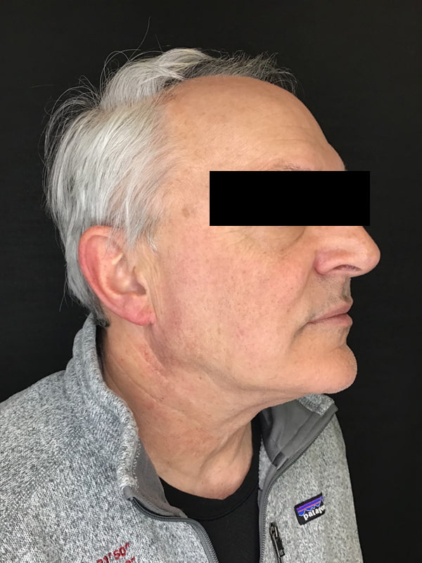 Sciton BBL Before & After Image