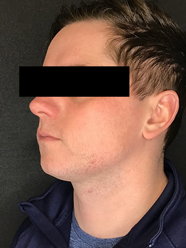 Sciton BBL Before & After Image