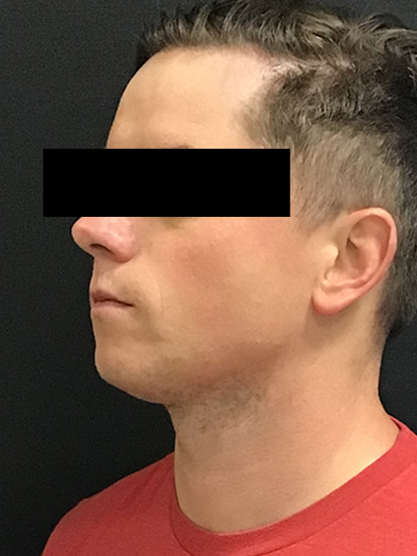 Sciton BBL Before & After Image