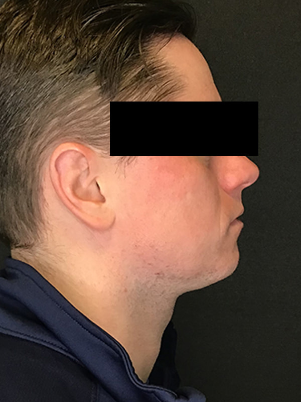 Sciton BBL Before & After Image