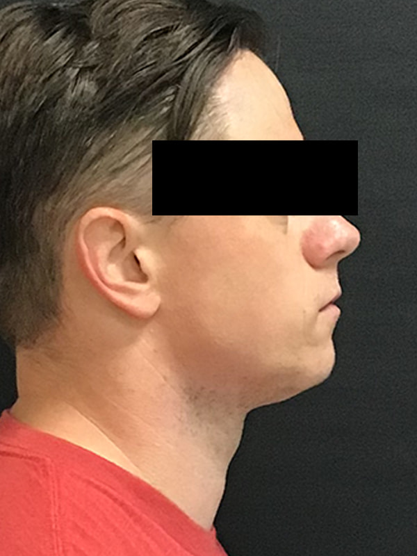 Sciton BBL Before & After Image