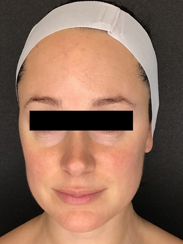 Sciton BBL Before & After Image
