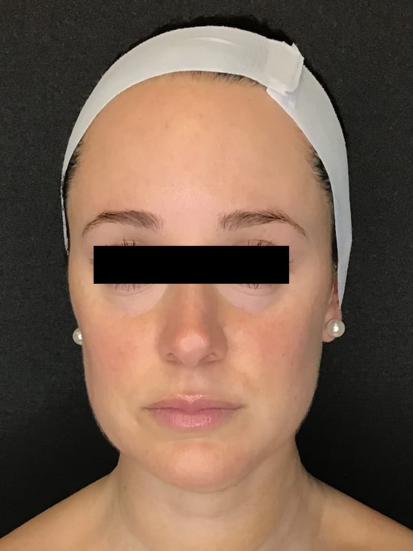 Sciton BBL Before & After Image