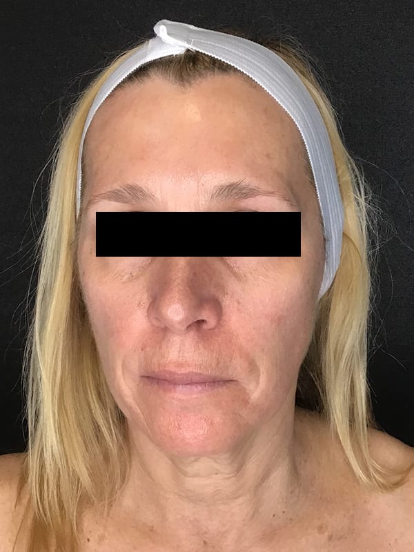 Sciton BBL Before & After Image
