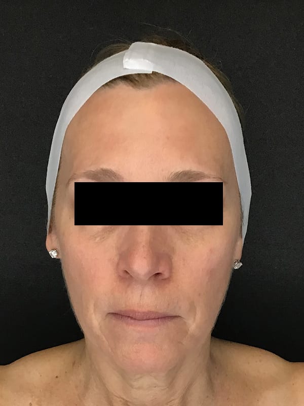 Sciton BBL Before & After Image