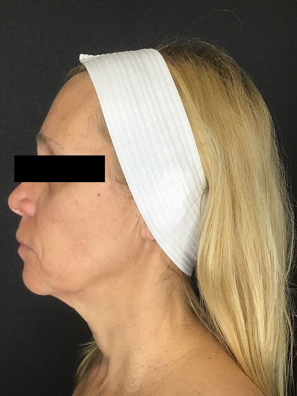 Sciton BBL Before & After Image