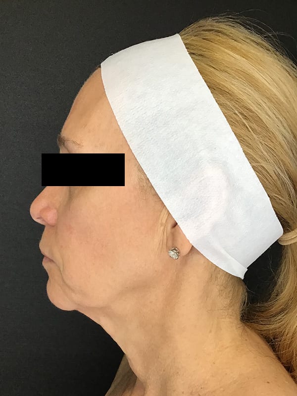 Sciton BBL Before & After Image