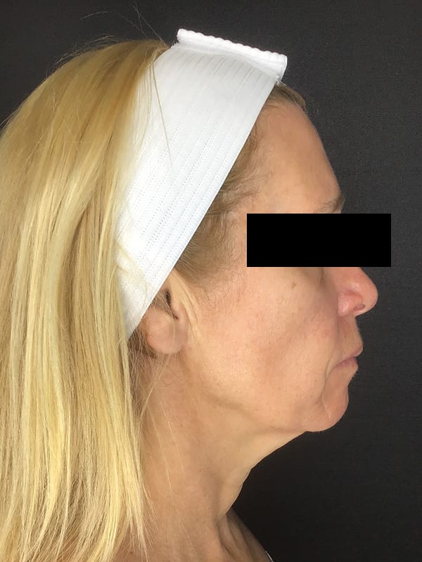 Sciton BBL Before & After Image
