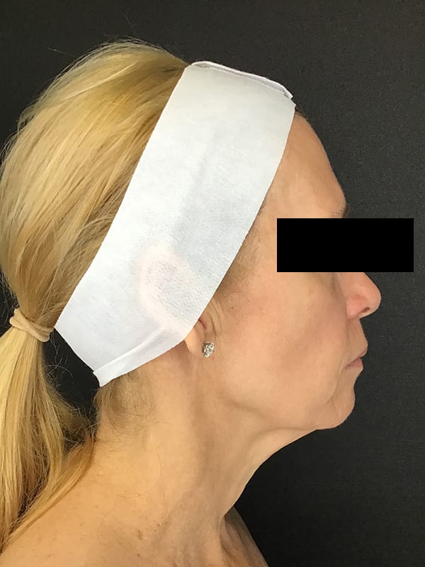 Sciton BBL Before & After Image