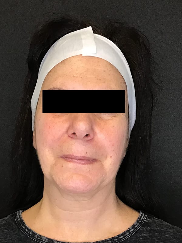 Sciton BBL Before & After Image