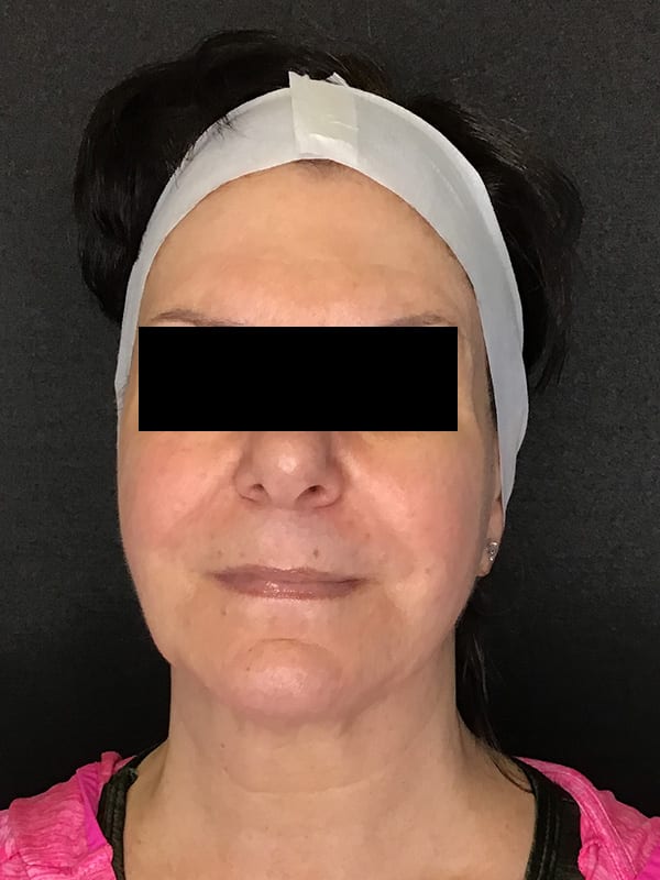 Sciton BBL Before & After Image
