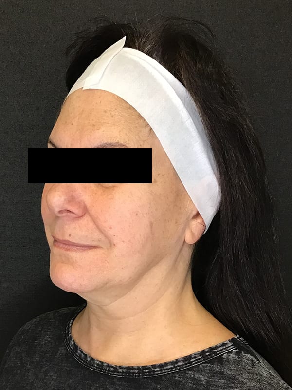 Sciton BBL Before & After Image