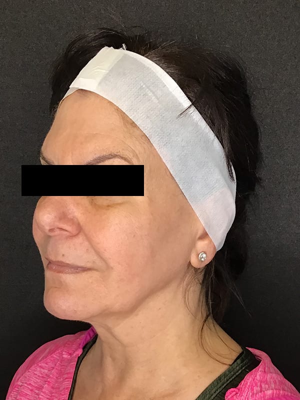 Sciton BBL Before & After Image