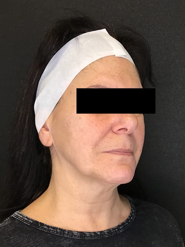 Sciton BBL Before & After Image