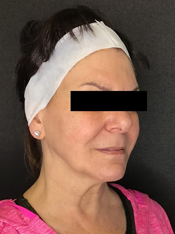Sciton BBL Before & After Image