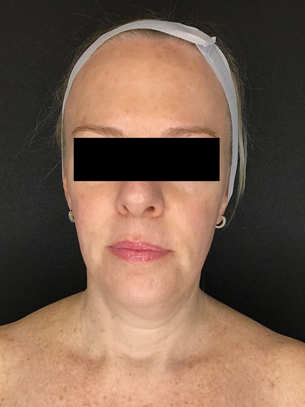 Sciton BBL Before & After Image