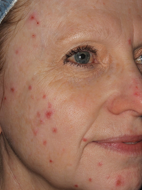Sciton BBL Before & After Image