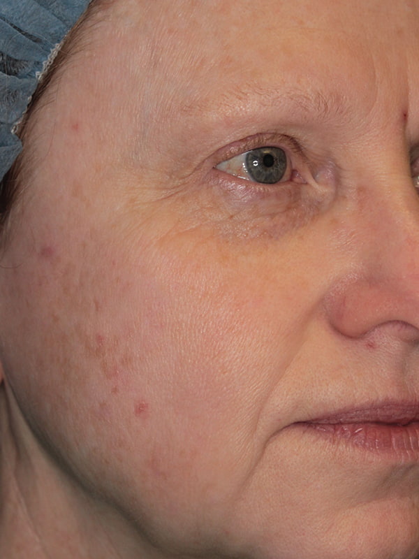 Sciton BBL Before & After Image