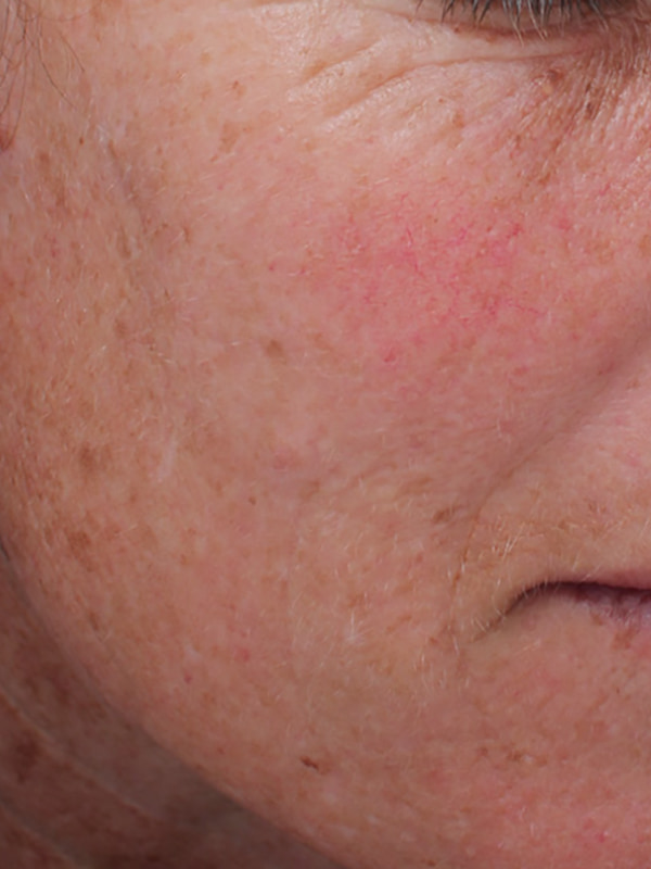 Sciton BBL Before & After Image