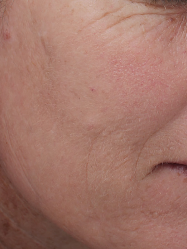 Sciton BBL Before & After Image