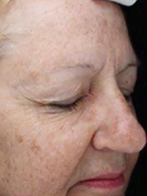 Sciton BBL Before & After Image