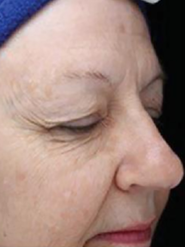 Sciton BBL Before & After Image