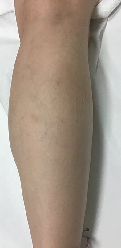 Spider Vein Treatment Before & After Image