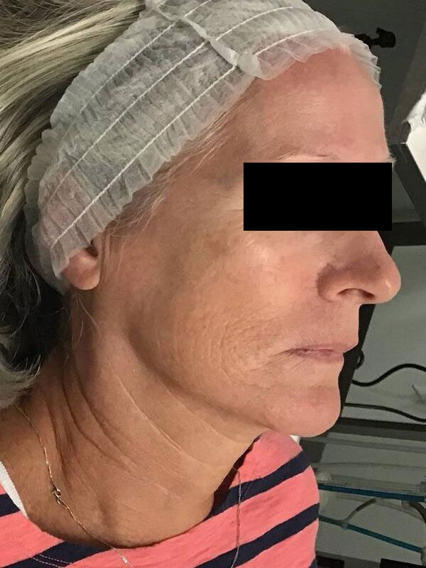 VI Body Peels Before & After Image