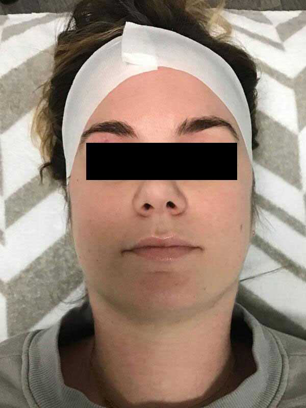 Hydrafacial Before & After Image