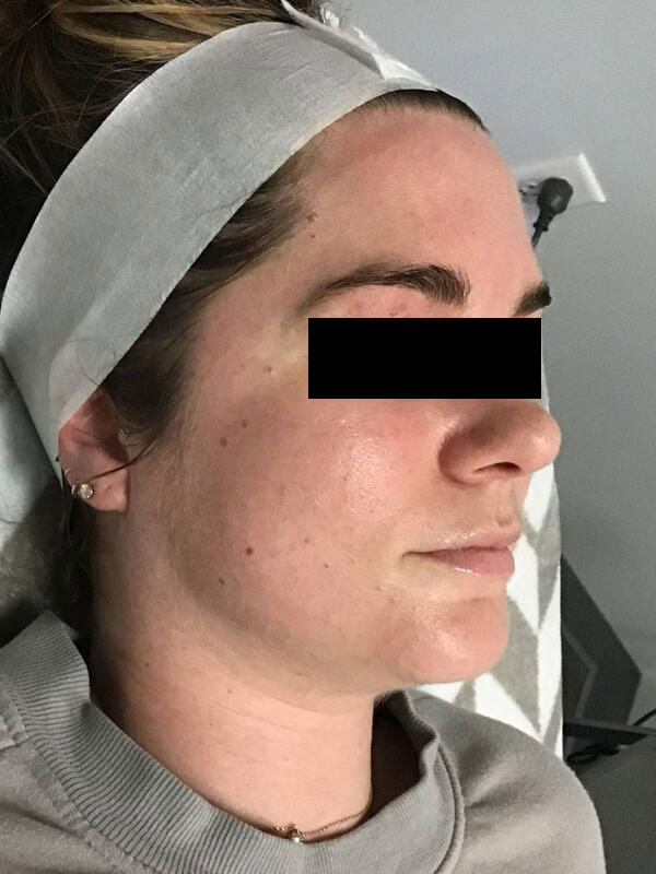 Hydrafacial Before & After Image