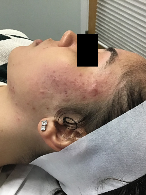 Hydrafacial Before & After Image