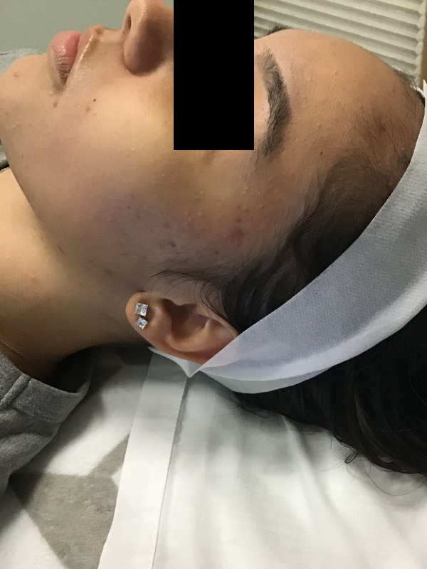 Hydrafacial Before & After Image