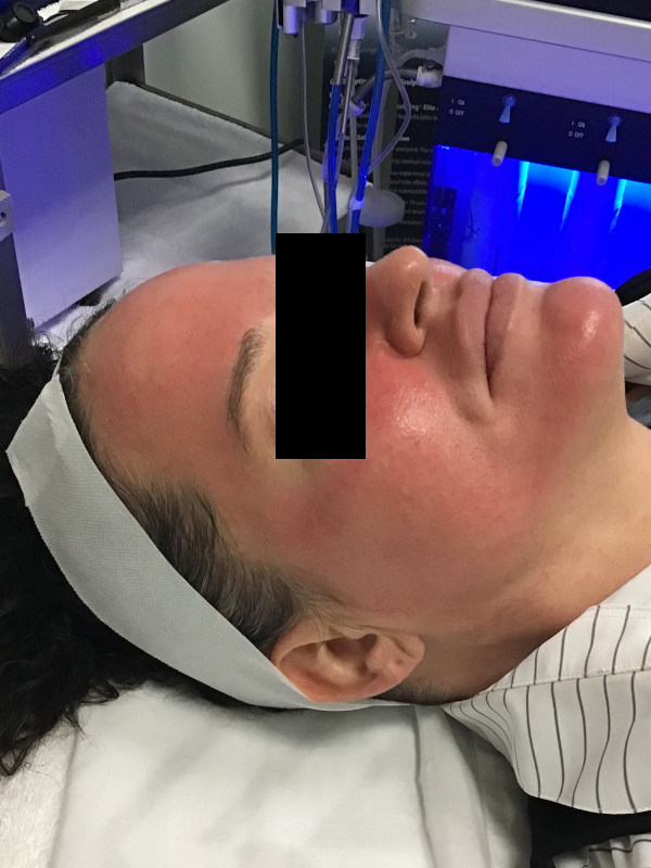 Hydrafacial Before & After Image