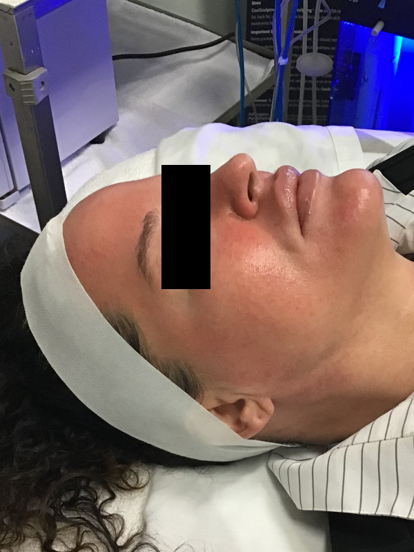 Hydrafacial Before & After Image
